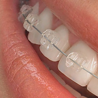 ワイヤブラケット法矯正が行われている歯のアップ